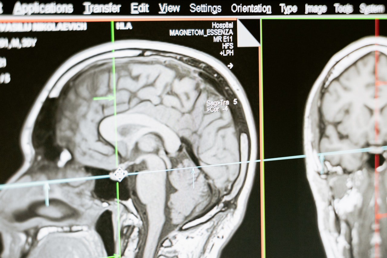 Jak COVID ovlivňuje mozek – mozková mlha